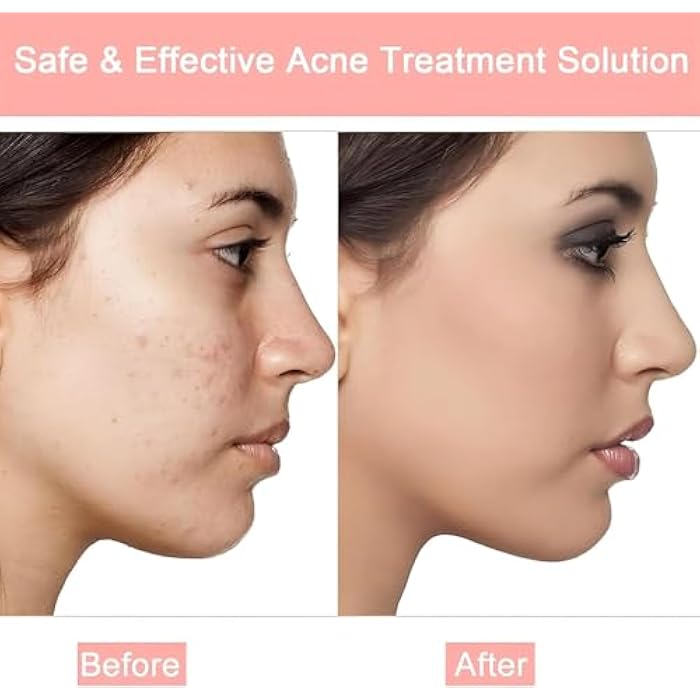 Water Spot Patches for Acne Cold Sores Skin Color Transparent Pill Sticker 8 Hours to Dry It Absorbs Bacteria in the Pimple Faster Prevent Scar…24 Pcs - Image 5